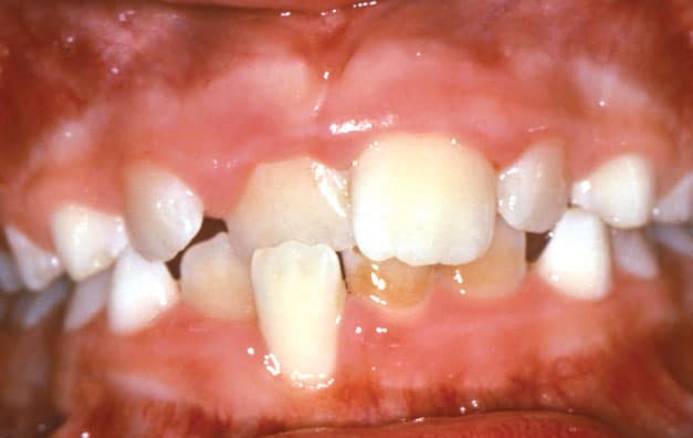 Crossbite Studio City Orthodontist in Studio City, CA