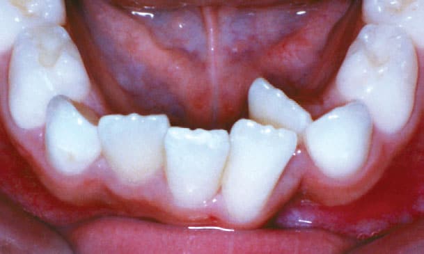 Crowding Studio City Orthodontist in Studio City, CA
