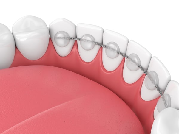 Fixed Retainers Studio City Orthodontist in Studio City, CA
