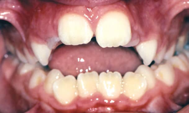 Open Bite Studio City Orthodontist in Studio City, CA
