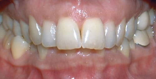 Overbite Studio City Orthodontist in Studio City, CA