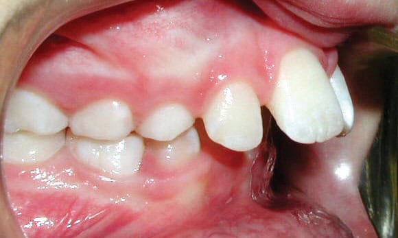 Protrusion Studio City Orthodontist in Studio City, CA