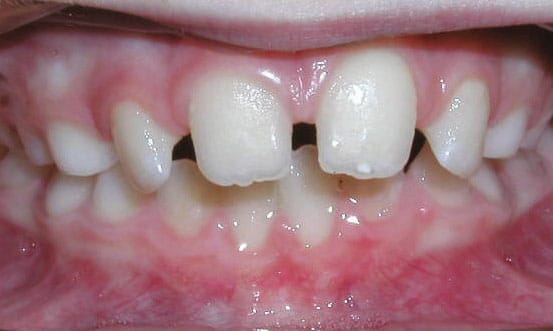 Spacing Studio City Orthodontist in Studio City, CA