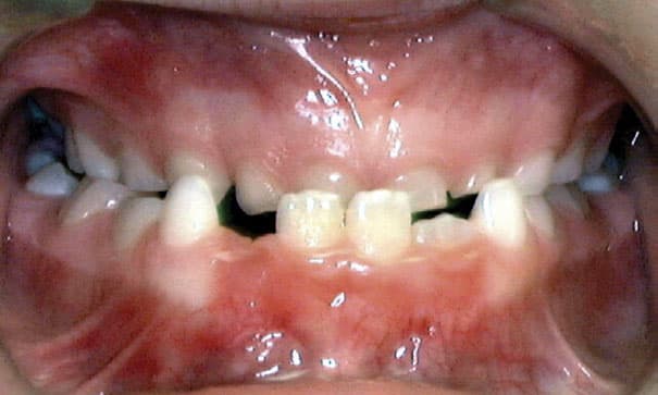 Underbite Studio City Orthodontist in Studio City, CA